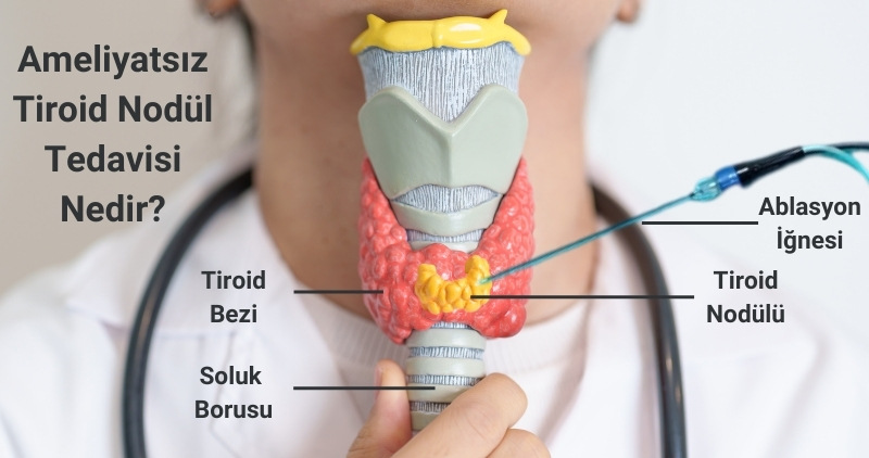 Ameliyatsız Tiroid Nodül Tedavisi Nedir?, Antalya, Muratpaşa, İstanbul, Ankara