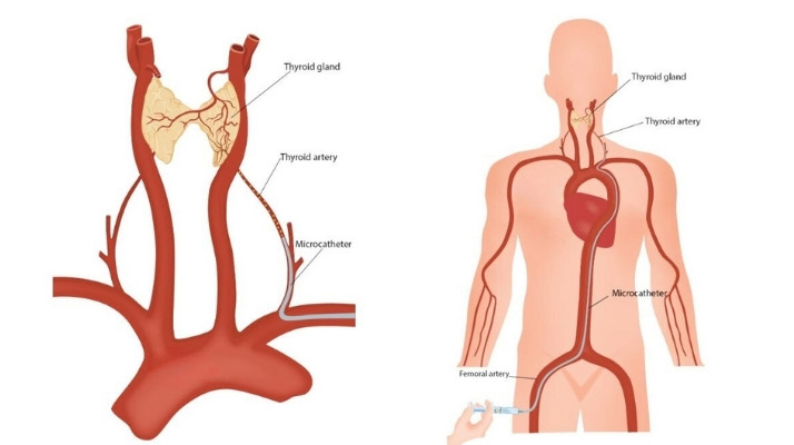 Tiroid Arter Embolizasyon Tedavisi Ne Zaman Uygulanır? Antalya, Muratpaşa, İstanbul, Ankara Lara