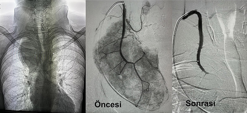 Tiroid Arter Embolizasyon Tedavisi Öncesi & Sonrası 1, Antalya, İstanbul, Ankara Muratpaşa, Lara