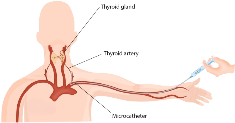 Tiroid Arter Embolizasyon Tedavisi Fiyatları Antalya, Muratpaşa, İstanbul, Ankara Lara