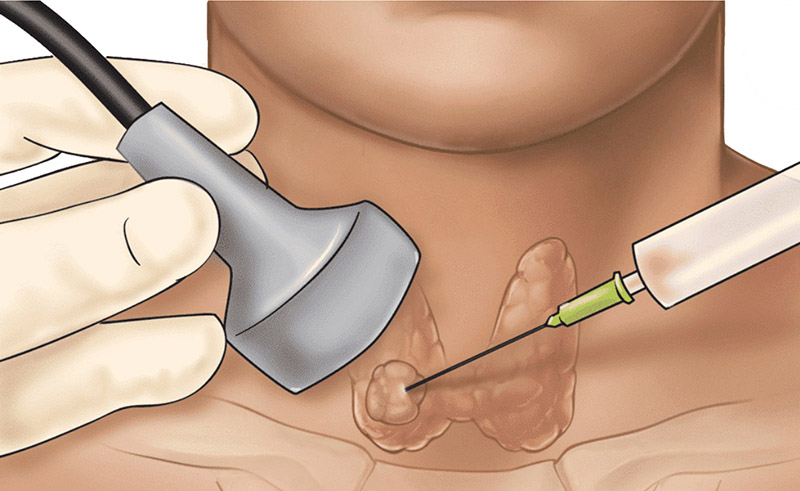 Thyroid Nodule Biopsy, Thyroid Biopsy Cost, Ankara, Istanbul, Antalya