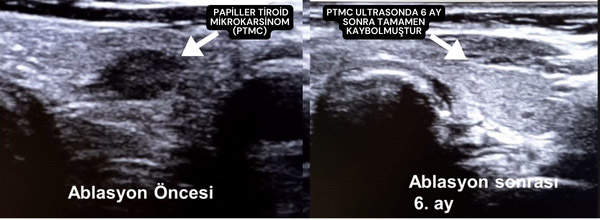 Tiroid Kanseri Tedavisi, Termal Ablasyon Öncesi ve Sonrası Antalya, Muratpaşa