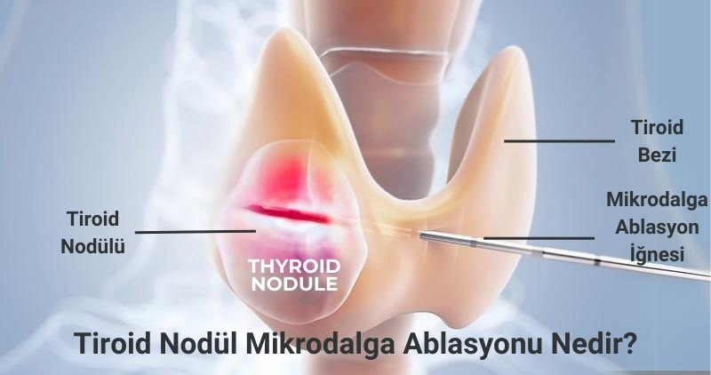 Tiroid Nodül Mikrodalga Ablasyonu (MWA) Nedir?, Fiyatları, Antalya, İstanbul, Ankara, Muratpaşa