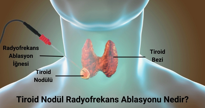 Tiroid Nodül Radyofrekans Ablasyonu (RFA), Fiyatları, Antalya, İstanbul, Ankara, Muratpaşa