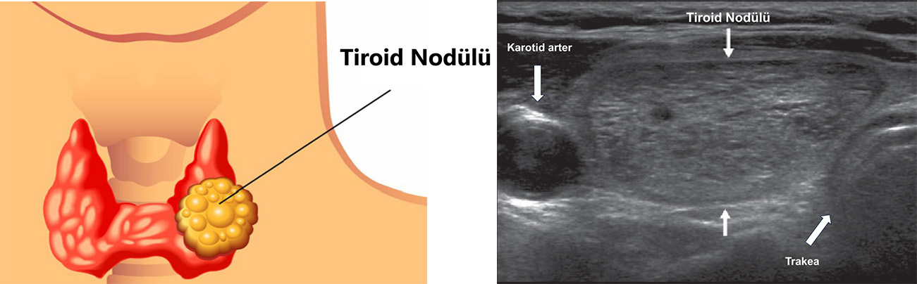 Tiroid Nodülü Nedir?